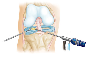 lesions-de-menisc-fisioisalut-lagarriga-3